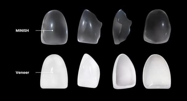 MINISH veneer vs traditional veneer comparison - ultra-thin translucent MINISH on top, white porcelain veneer on bottom